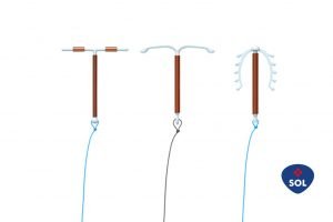 DIU de Cobre: conheça os diferentes tipos